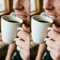 Smoker's stains before and noticeably whiter teeth after peroxide-free mouthwash